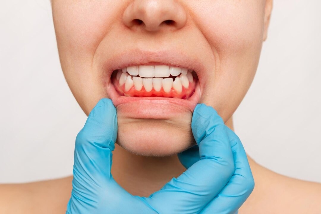 gum grafts
