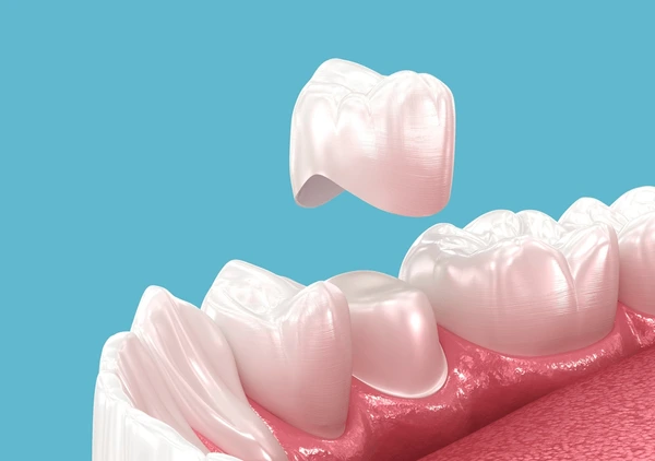 dental-crown