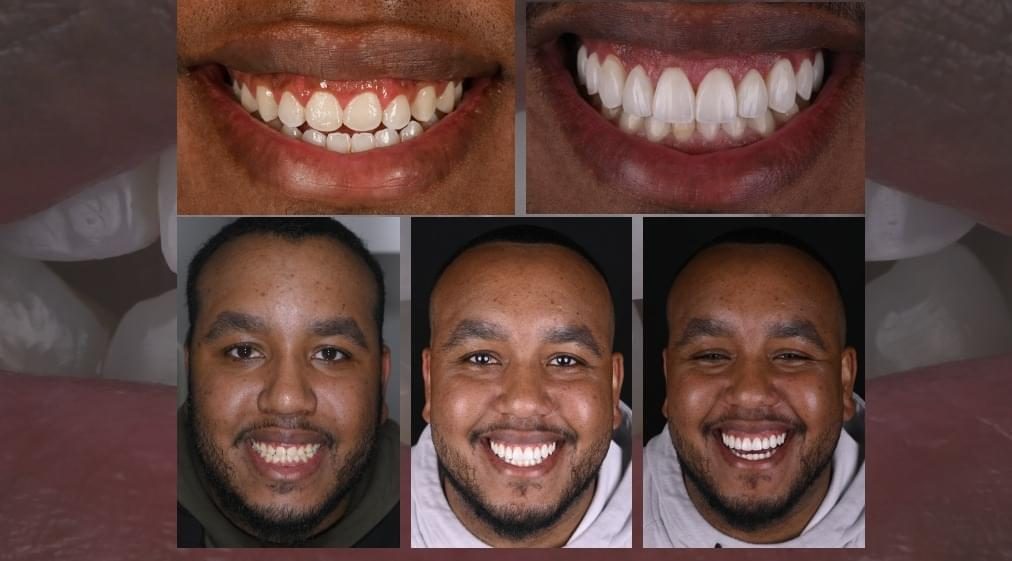 Before and after composite treatment, close up and full smile