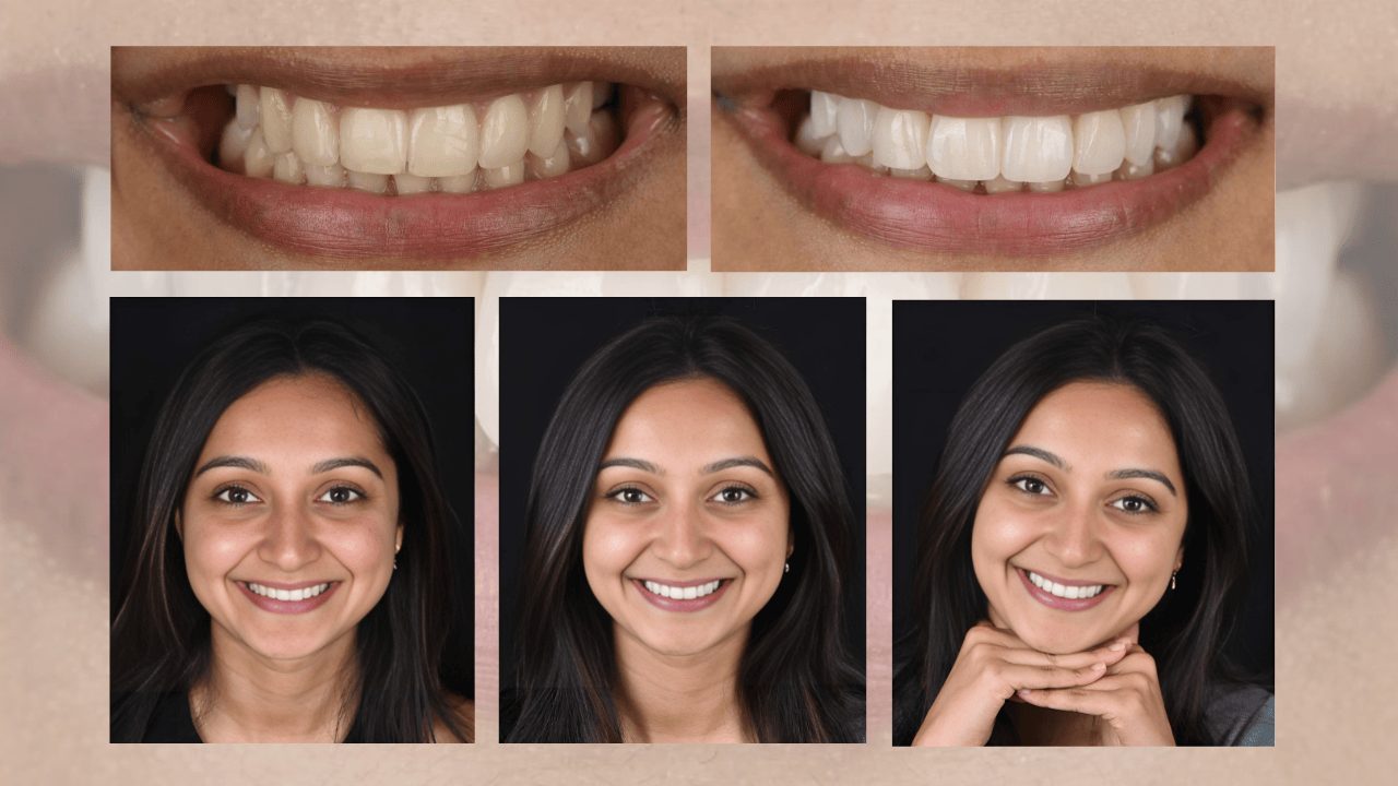 Before and after conservative smile design, close up and full smile